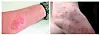Skin rashes and itchiness accompany bedbug bites. [KOREA DISEASE CONTROL AND PREVENTION AGENCY]