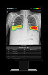 Screen image of Lunit's AI-powered chest screening software, Lunit Insight CXR [LUNIT]