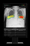 Screen image of Lunit's AI-powered chest screening software, Lunit Insight CXR [LUNIT]