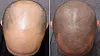 Before, left, and after scalp micropigmentation [ONLINE SCREEN GRAB]
