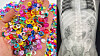 Water beads, left, and an X-ray image of the 10-month-old infant in the United States who died after swallowing them [CONSUMER PRODUCT SAFETY COMMISSION]
