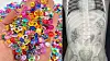 Water beads, left, and an X-ray image of the 10-month-old infant in the United States who died after swallowing them [CONSUMER PRODUCT SAFETY COMMISSION]
