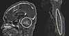 An MRI of a pediatric patient with a brain tumor called medulloblastoma shows the spread of cancerous cells to the spinal cord. [SEOUL NATIONAL UNIVERSITY HOSPITAL]