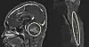 An MRI of a pediatric patient with a brain tumor called medulloblastoma shows the spread of cancerous cells to the spinal cord. [SEOUL NATIONAL UNIVERSITY HOSPITAL]