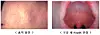 Measles rash cases [JOONGANG ILBO]