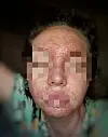 A photo of the inflammed pustules that spread over Charlotte's face, which she provided to the Korea JoongAng Daily. [CHARLOTTE]