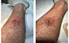 From left, the lump on Ben's right leg before his operation and after the stitches inserted by his surgeon began to fail. [BEN]