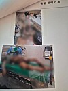 Two large blurred medical photos mounted on a wall with Korean text above them.